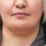 Scarless Facelift and Necklift Before & After Patient #3094