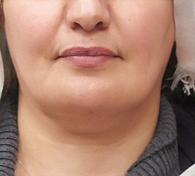Scarless Facelift and Necklift Before & After Patient #3094