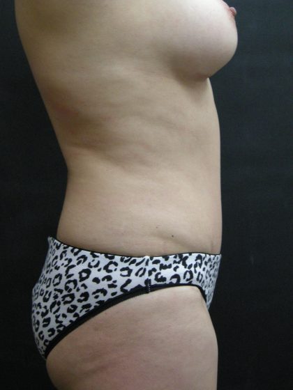 Mommy Makeover Before & After Patient #2657