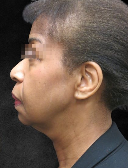 Fat Transfer Before & After Patient #1770