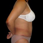 Tummy Tuck Before & After Patient #3146