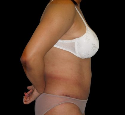Tummy Tuck Before & After Patient #3146