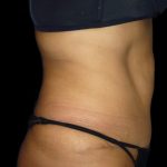 Tummy Tuck Before & After Patient #3155