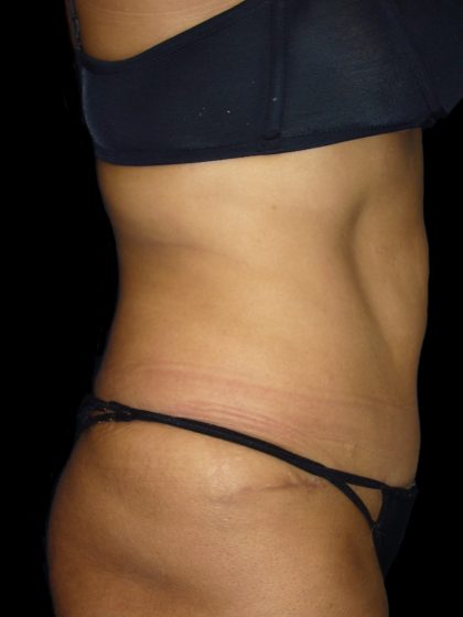 Tummy Tuck Before & After Patient #3155