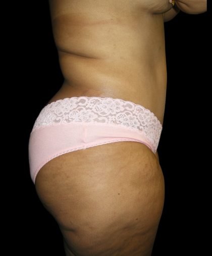 Tummy Tuck Before & After Patient #3166