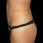 Tummy Tuck Before & After Patient #3175