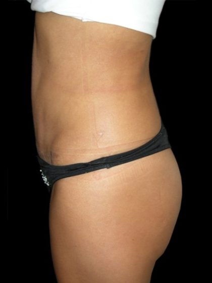 Tummy Tuck Before & After Patient #3175