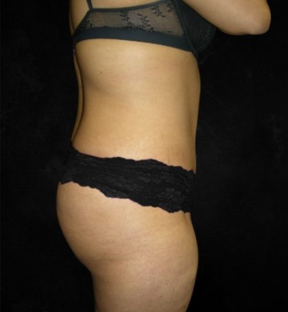 Tummy Tuck Before & After Patient #3186