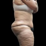 Tummy Tuck Before & After Patient #3209