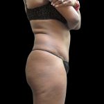 Tummy Tuck Before & After Patient #3216