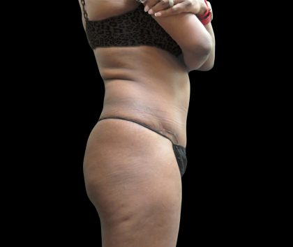 Tummy Tuck Before & After Patient #3216