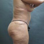 Tummy Tuck Before & After Patient #3225