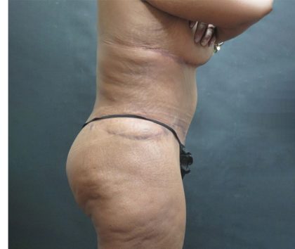 Tummy Tuck Before & After Patient #3225