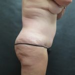 Tummy Tuck Before & After Patient #3245
