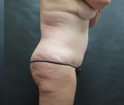 Tummy Tuck Before & After Patient #3245