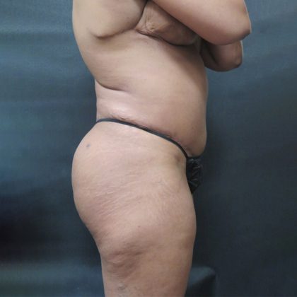 Tummy Tuck Before & After Patient #3254