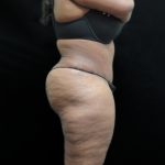 Tummy Tuck Before & After Patient #3267