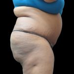 Tummy Tuck Before & After Patient #3279