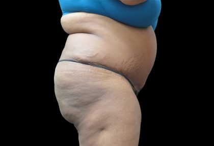 Tummy Tuck Before & After Patient #3279