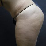 Tummy Tuck Before & After Patient #3286