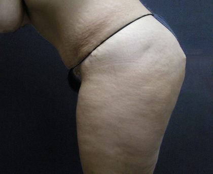 Tummy Tuck Before & After Patient #3286