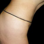 Tummy Tuck Before & After Patient #3293