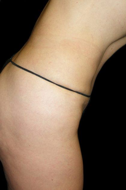 Tummy Tuck Before & After Patient #3293