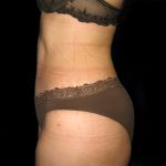 Tummy Tuck Before & After Patient #3300