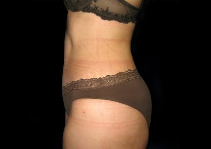 Tummy Tuck Before & After Patient #3300