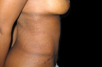 Tummy Tuck Before & After Patient #3305