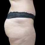 Tummy Tuck Before & After Patient #3312