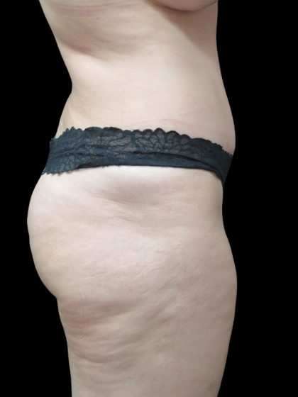 Tummy Tuck Before & After Patient #3312