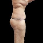 Tummy Tuck Before & After Patient #3326