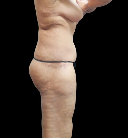 Tummy Tuck Before & After Patient #3326