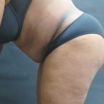 Tummy Tuck Before & After Patient #3333