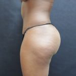 Tummy Tuck Before & After Patient #3345