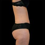 Tummy Tuck Before & After Patient #3357