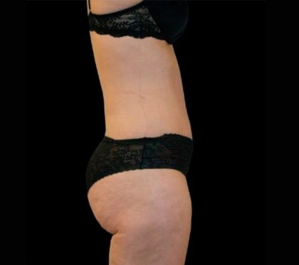 Tummy Tuck Before & After Patient #3357