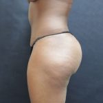 Mommy Makeover Before & After Patient #2607