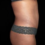 Tummy Tuck Before & After Patient #3366