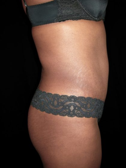 Tummy Tuck Before & After Patient #3366