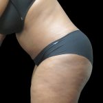 Tummy Tuck Before & After Patient #3380