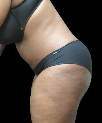 Tummy Tuck Before & After Patient #3380