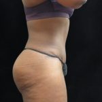 Tummy Tuck Before & After Patient #3387
