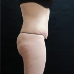 Tummy Tuck Before & After Patient #3396