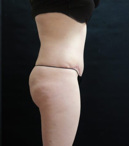 Tummy Tuck Before & After Patient #3396