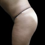 Tummy Tuck Before & After Patient #3403