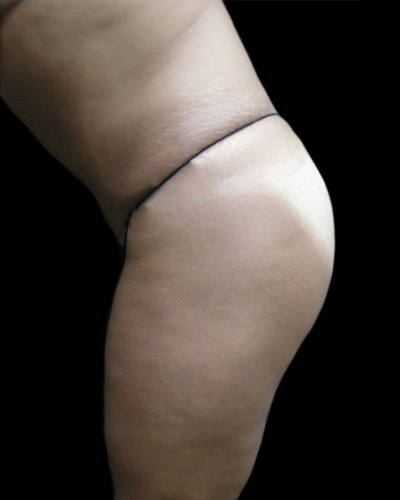 Tummy Tuck Before & After Patient #3403