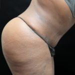 Tummy Tuck Before & After Patient #3412