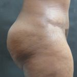 Tummy Tuck Before & After Patient #3419